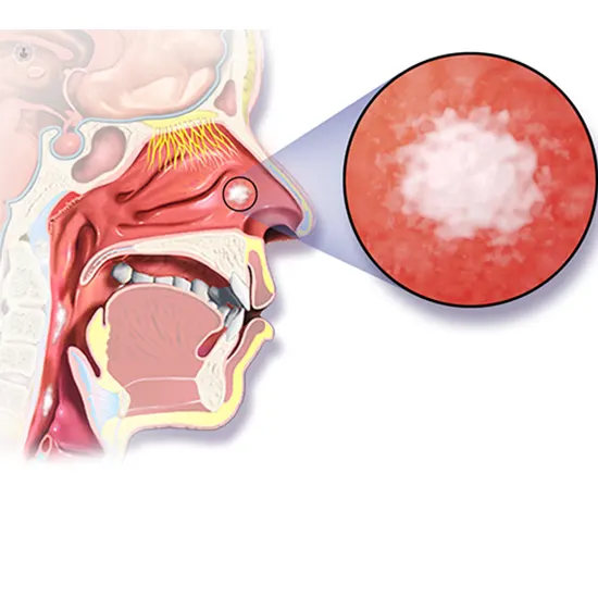 Paranasal Sinus and Nasal Cavity - Symptoms, Types, Causes & Diagnosis